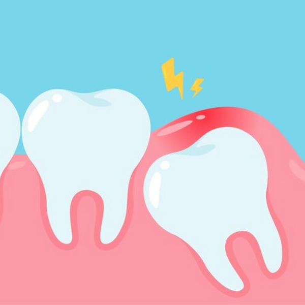 What is an impacted tooth?