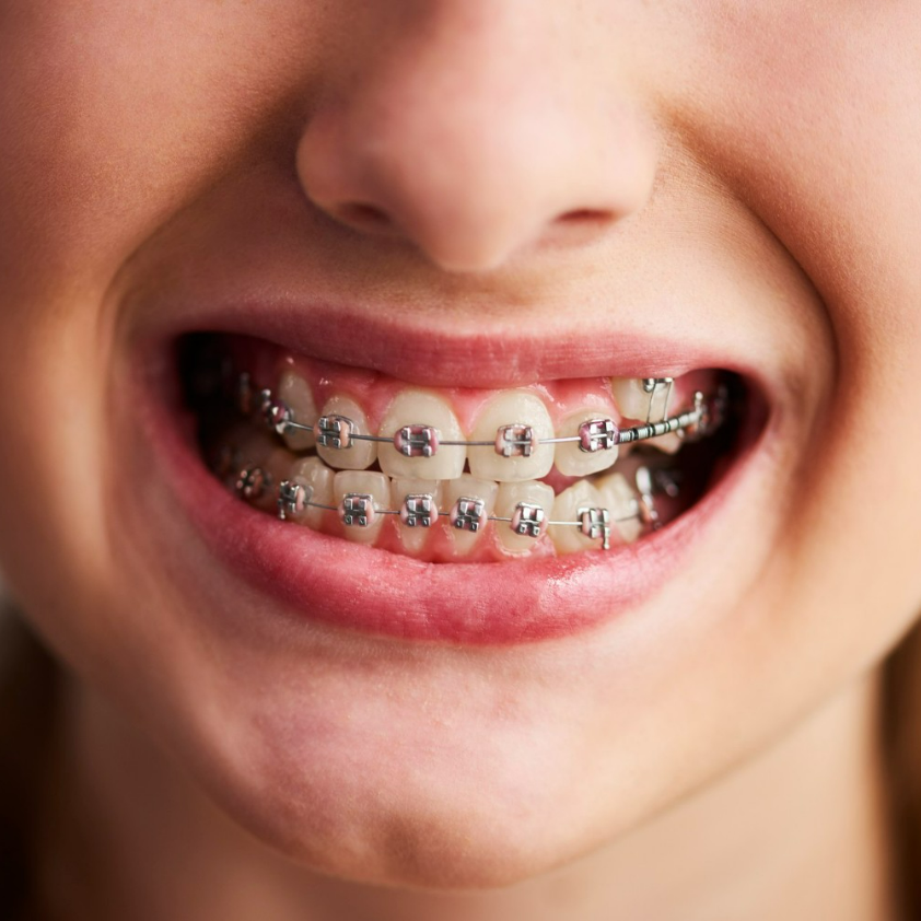 How to Floss With Braces? All You Need to Know - Oclean FAQs