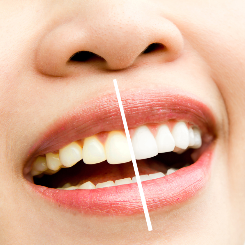 Does Coconut Oil Whiten Teeth? - Oclean FAQs