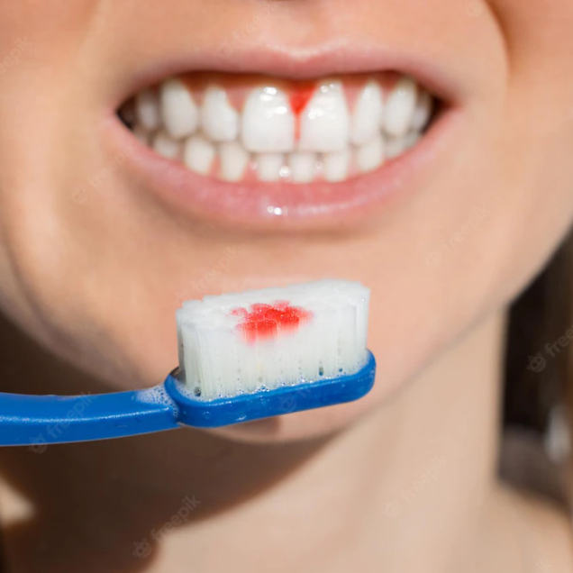 What Causes Bleeding Gums and How to Treat Them?
